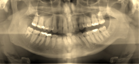 xray of my mouth